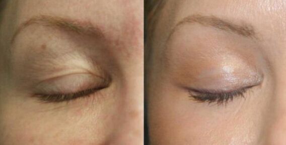 Territory care near the eyes