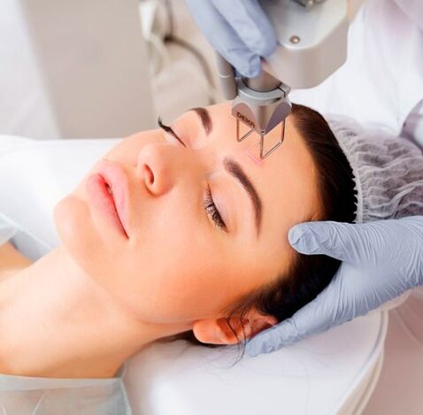 Laser rejuvenation of the face