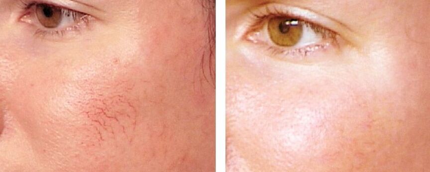 Rosacea's removal