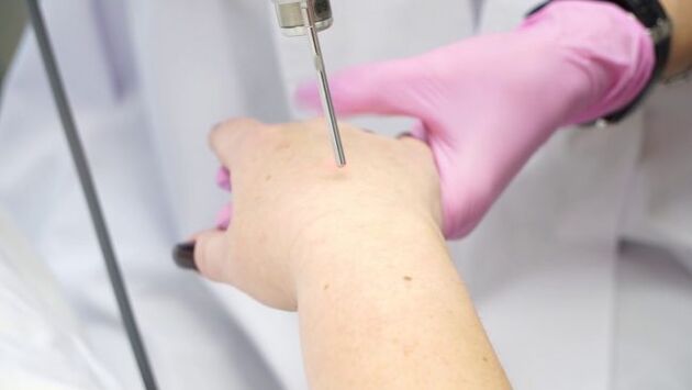 Rejuvenation of hand skin with laser