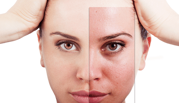 Fractional rejuvenation eliminates the main aesthetic flaws on the face