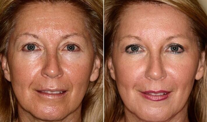 before and after skin rejuvenation at home