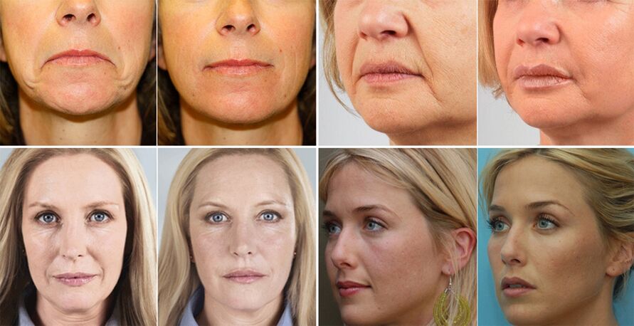 Photographs of women before and after facial rejuvenation