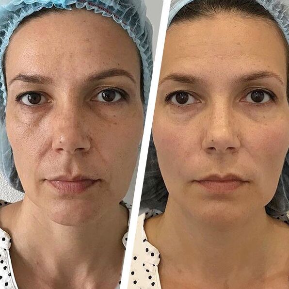 facial image before and after laser rejuvenation